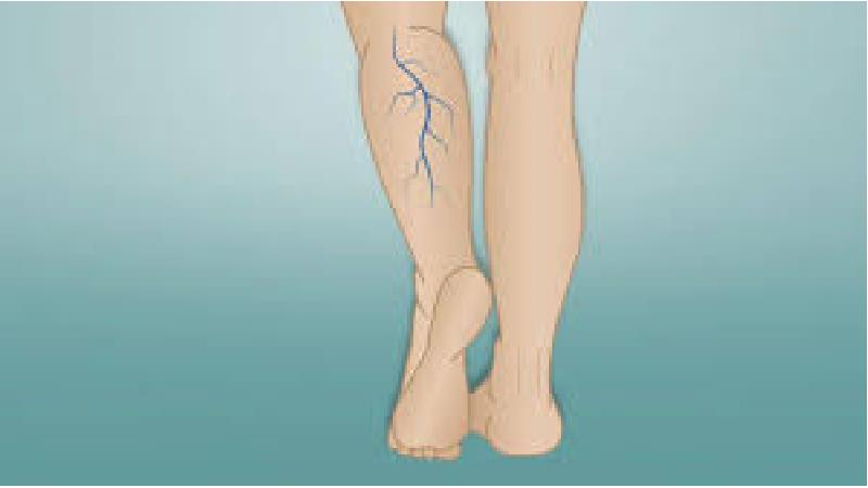 درمان فلبیت