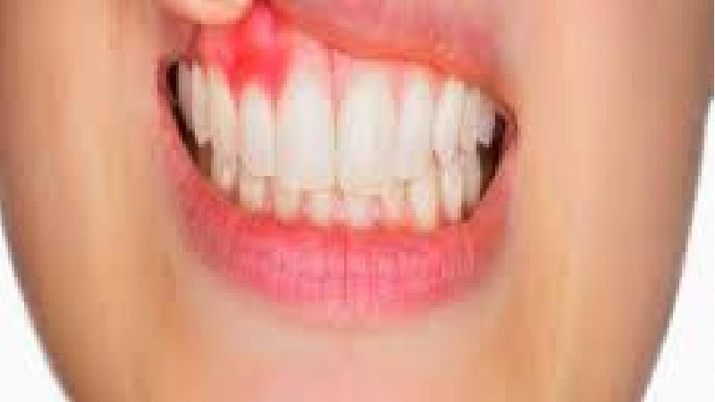 دلیل بیماری لثه