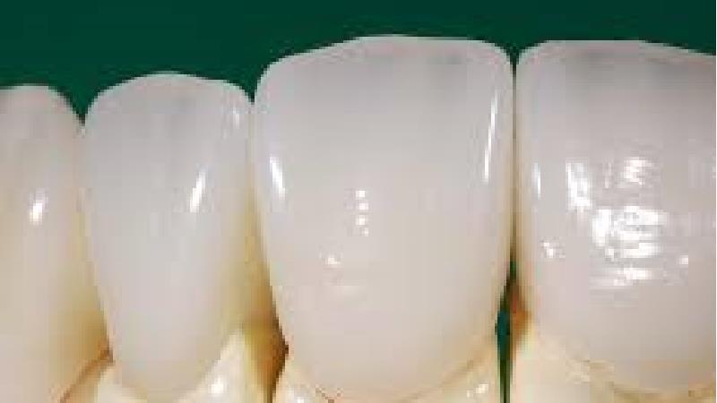 گلیز دندان چیست