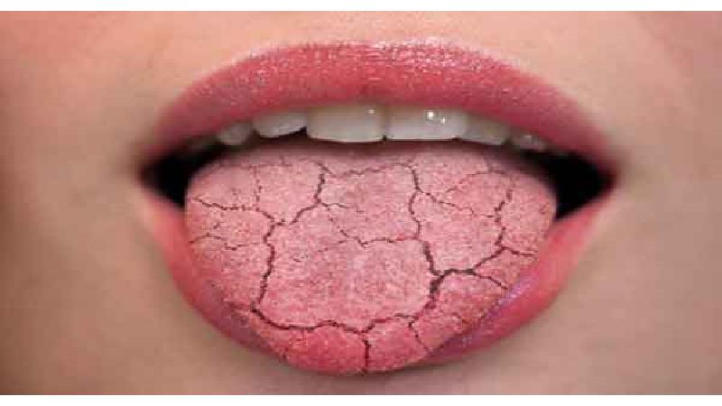 دلایل خشکی دهان