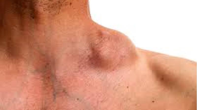 سرطان النفوم چطور درمان می شود