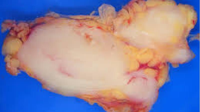 سرطان لنفوم چیست