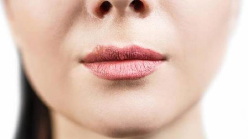 درمان تبخال