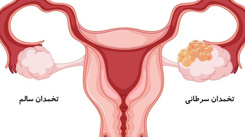 علایم اولیه سرطان تخم دان
