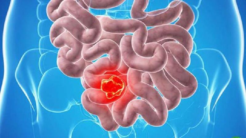 علایم سرطان روده