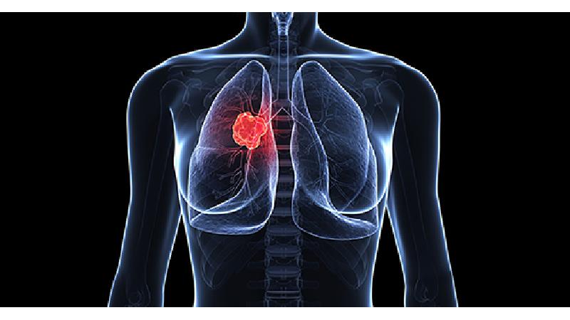 سرطان ریه در جوانان 