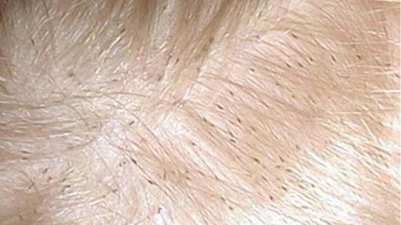 چگونه شپش سر کودک را از بین ببریم