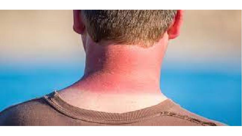 روش های درمان آفتاب سوختگی