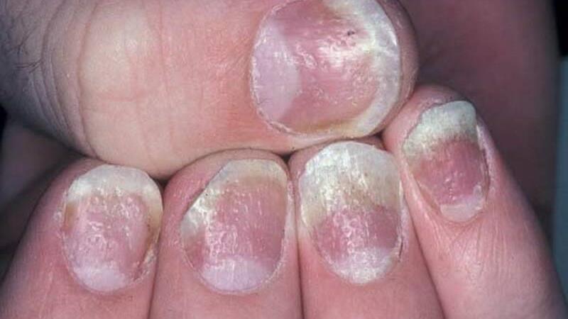 راه درمان بیماری پسوریازیس