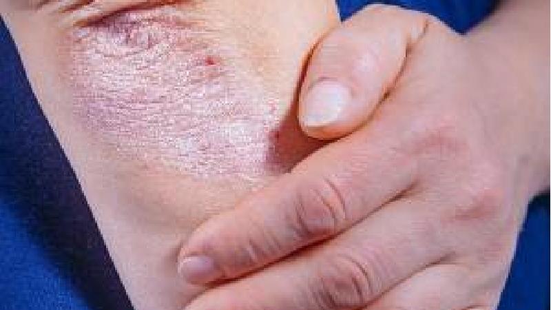 چطور پسوریازیس را درمان کنیم