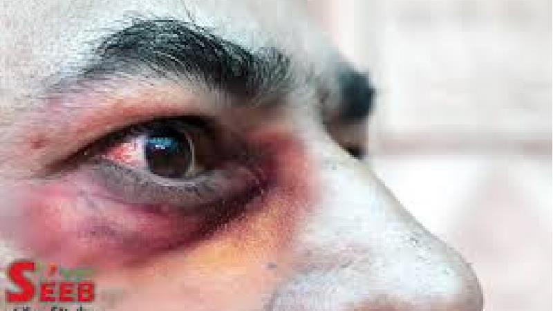 بیماری قارچ سیاه چیست