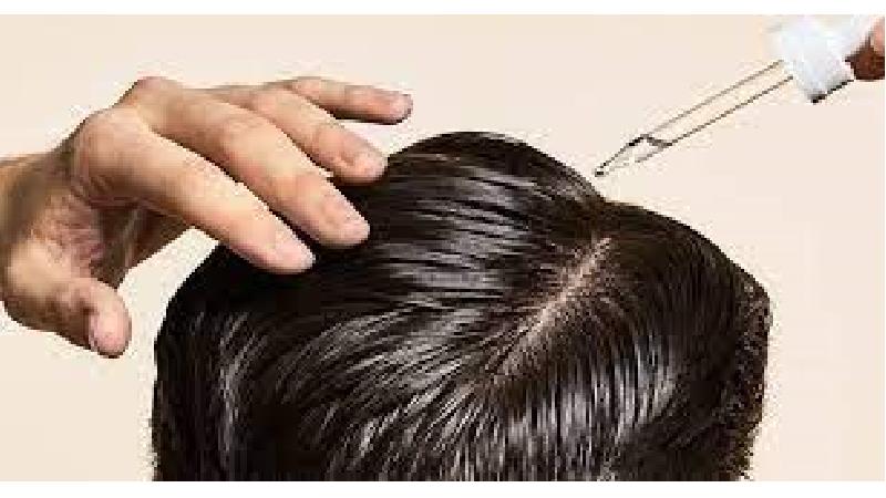 ریزش مو شدید