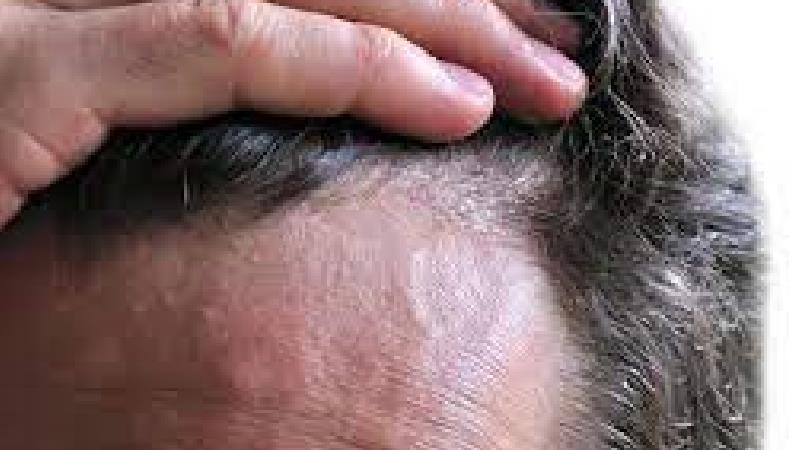 ریزش مو براثر کرونا