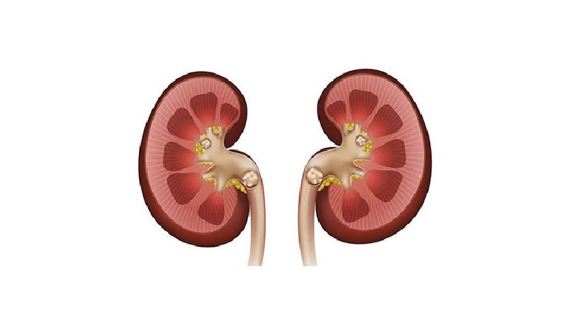 درمان خانگی سنگ کلیه