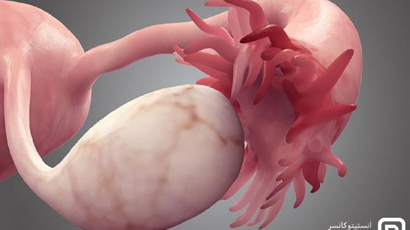 سرطان تخمدان