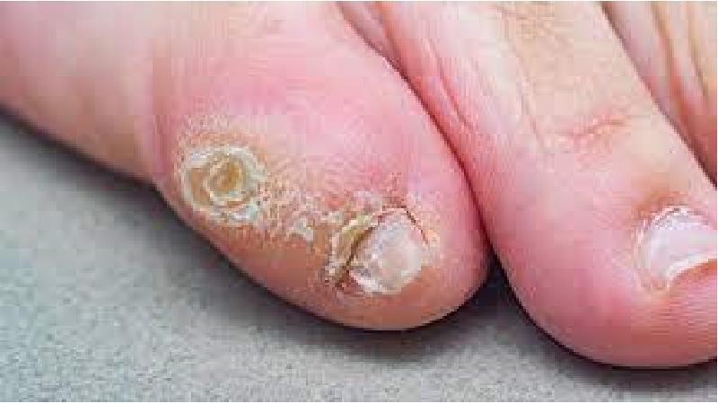 درمان میخچه