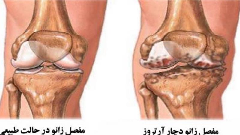آرتروز زانو